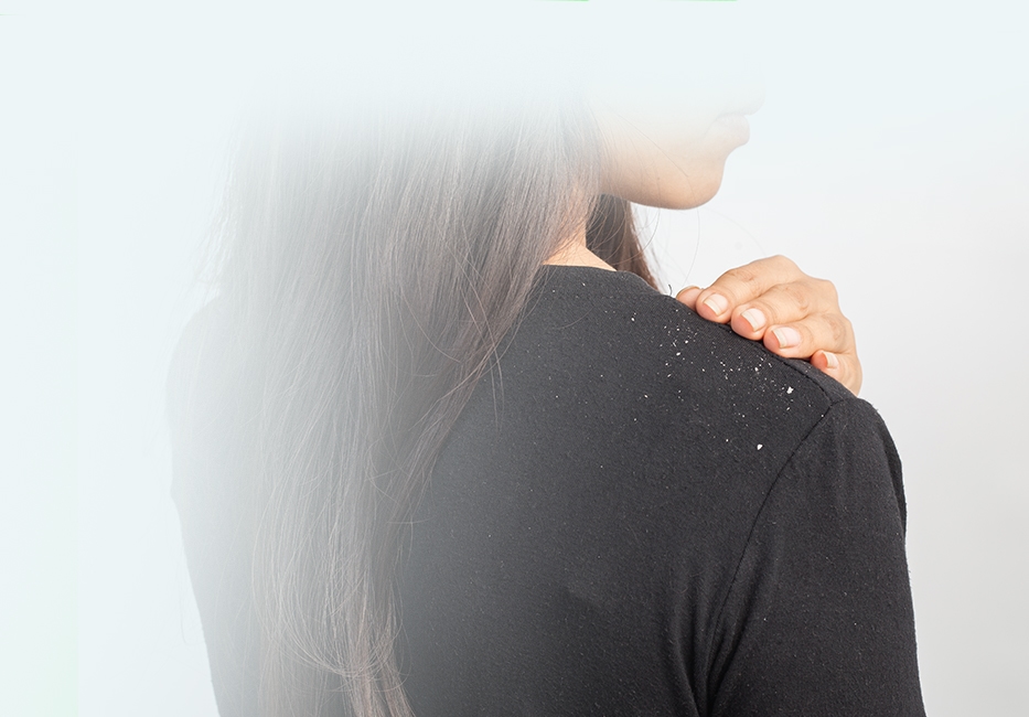 Dandruff Treatment