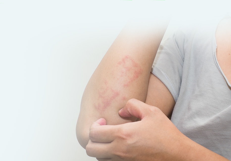 Eczema & Psoriasis Treatment