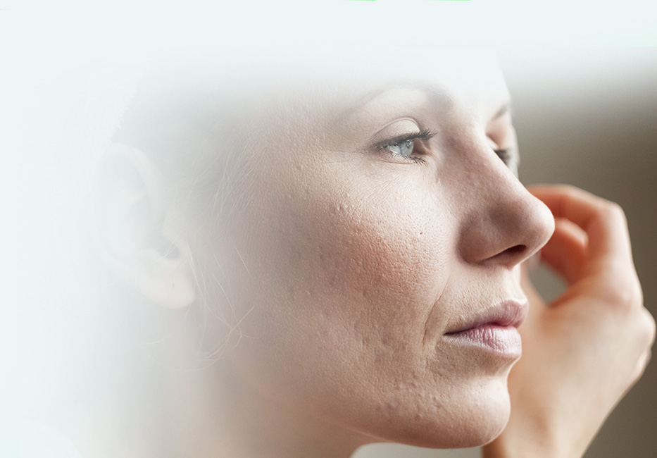 Rosacea Treatment