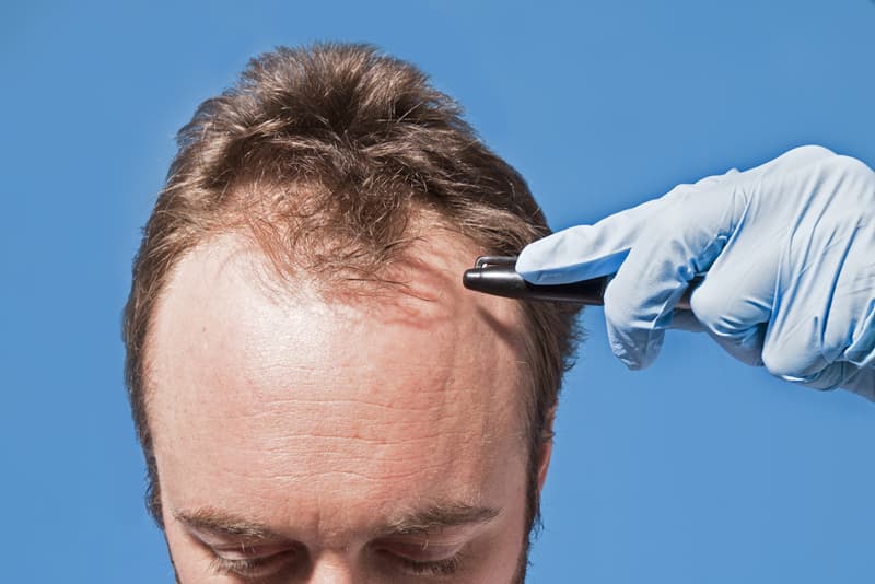 A man pointing a pen to his receding hairline