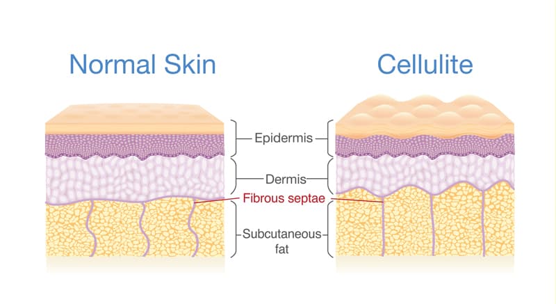 An illustration of normal skin vs skin with cellulite