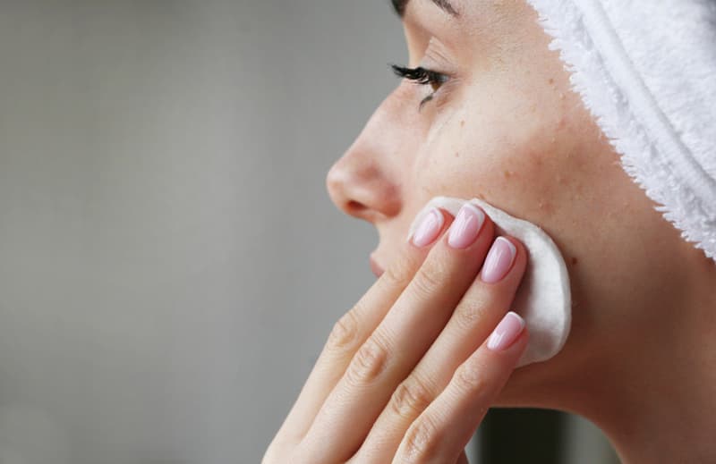 A lady wiping her acne laden face