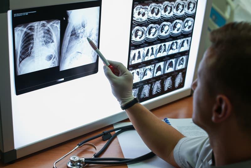 A doctor assessing an x-ray of a set of lungs