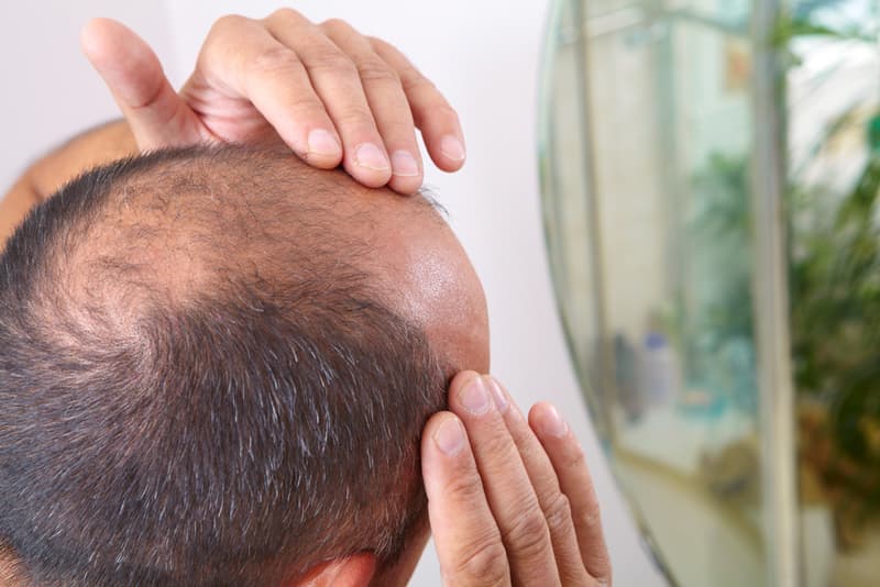 A man touching his balding head