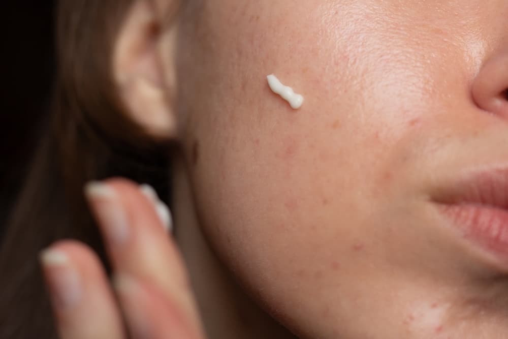 A lady applying tretinoin cream to her face