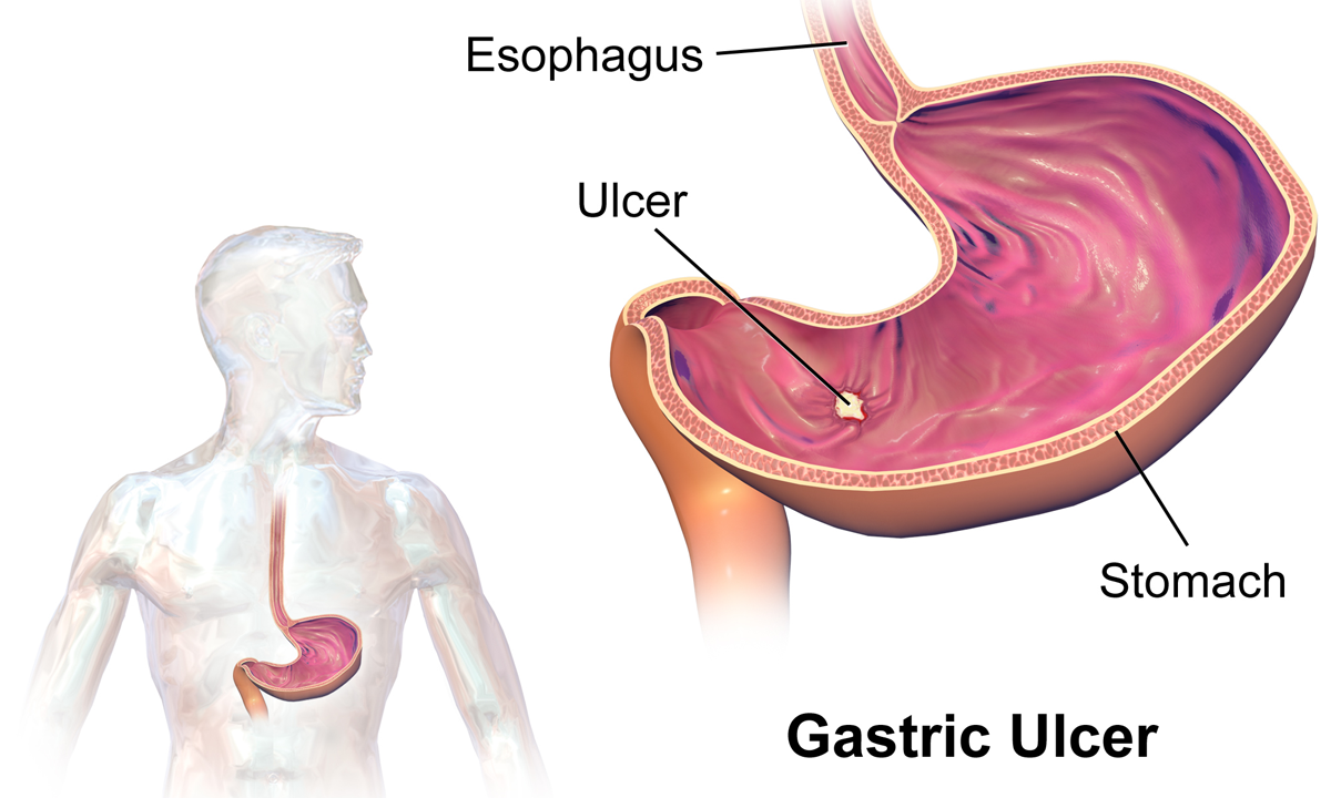 ulcers and acid reflux
